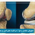 جراحی تعویض مفصل زانو (آرتروپلاستی) در شیراز