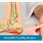 درمان خار پاشنه پا / علائم و علت در شیراز