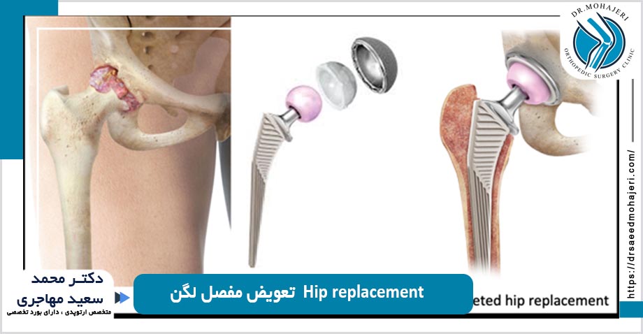  Hip replacement  تعویض مفصل لگن شیراز