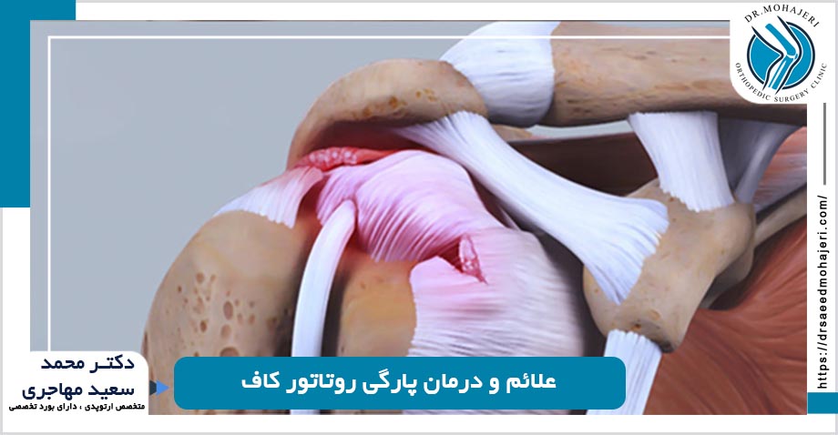 علائم و درمان پارگی روتاتور کاف در شیراز