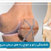 درمان شکستگی زانو در شیراز